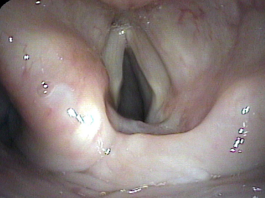 Endoscopic view of laryngeal opening six months after denervation-reinnervation surgery
