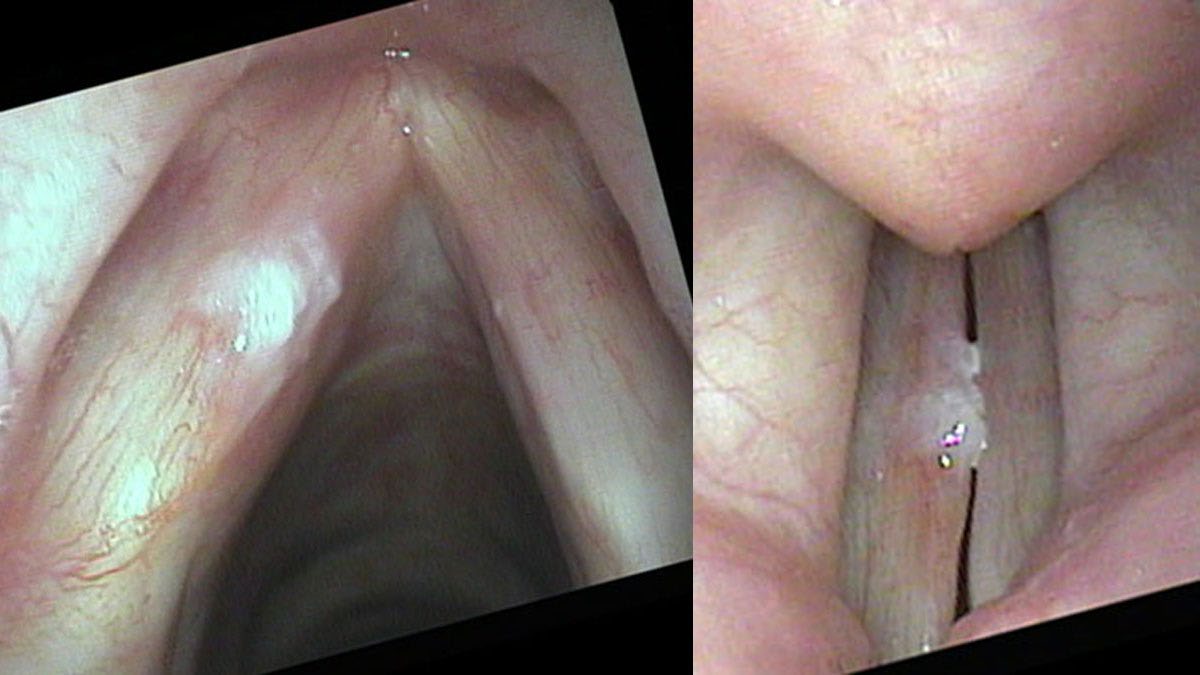 Leukoplakia on left vocal cord