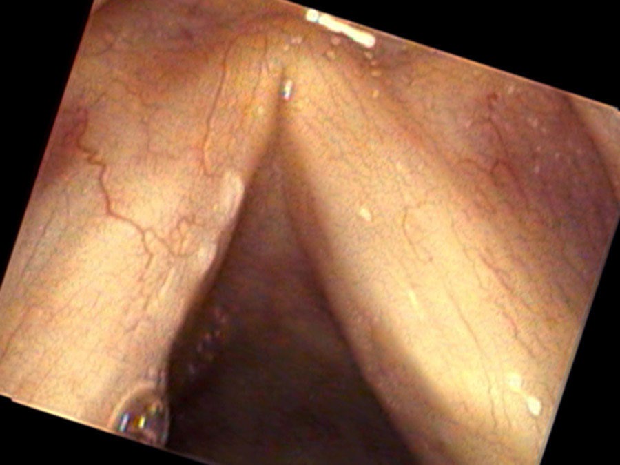 Two small white patches on left vocal cord with feeding blood vessels
