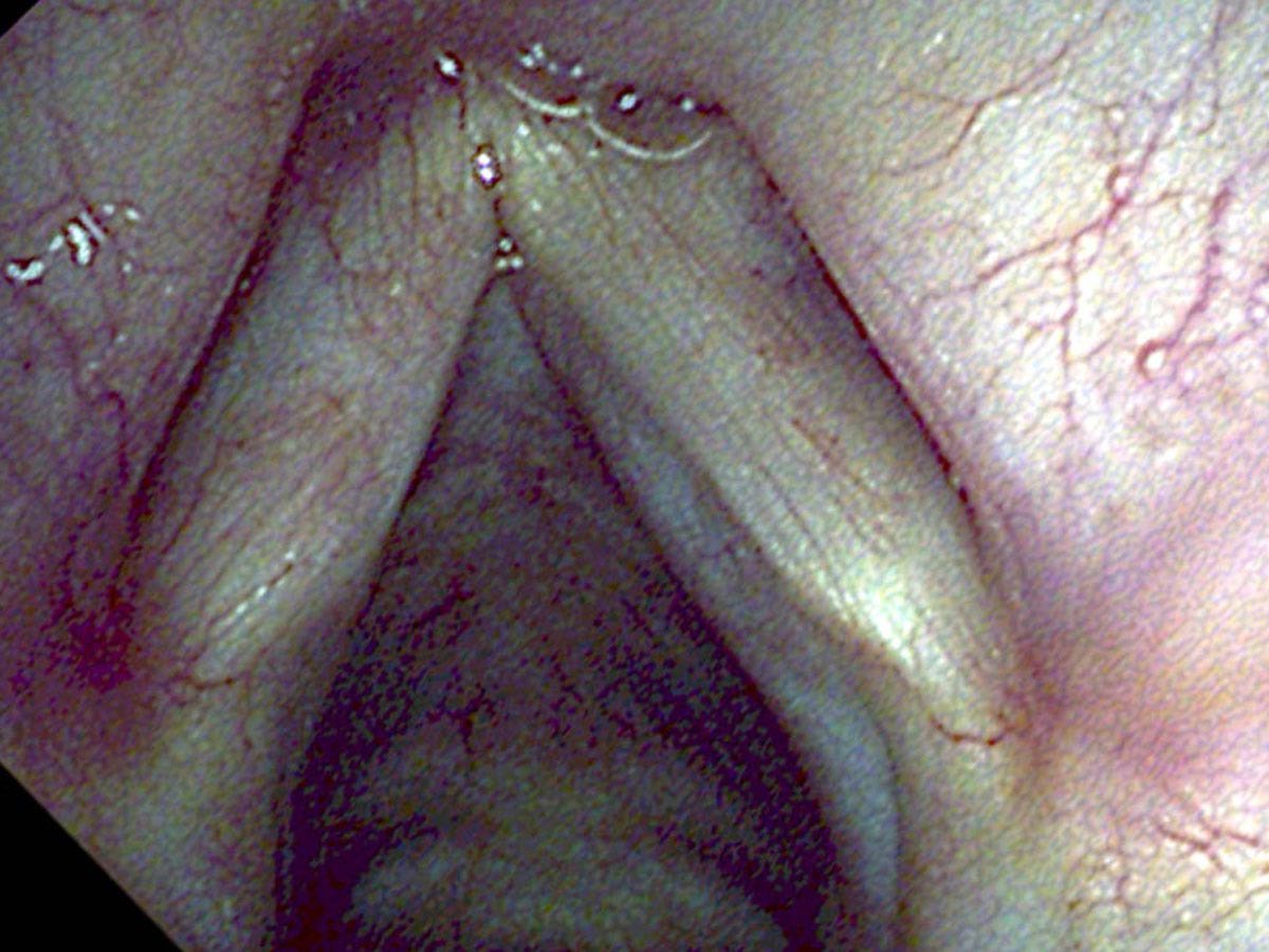 Vocal cords six months after KTP laser treatment