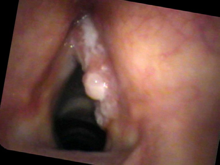 Rough irregular surface on right vocal cord suggestive of cancer