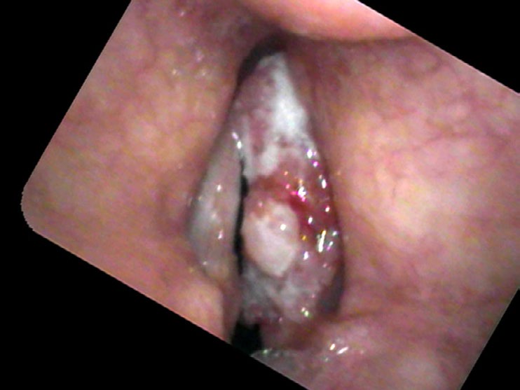 White patches and pebbled surface during vocal cord closure suggestive of cancer