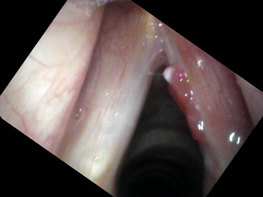 Granuloma on right vocal cord during healing after cancer removal