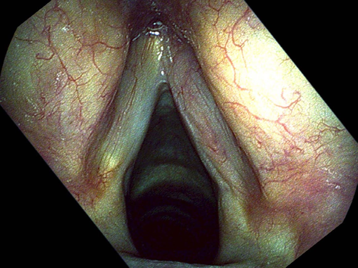 Right vocal cord smooth and straight six months after cancer removal
