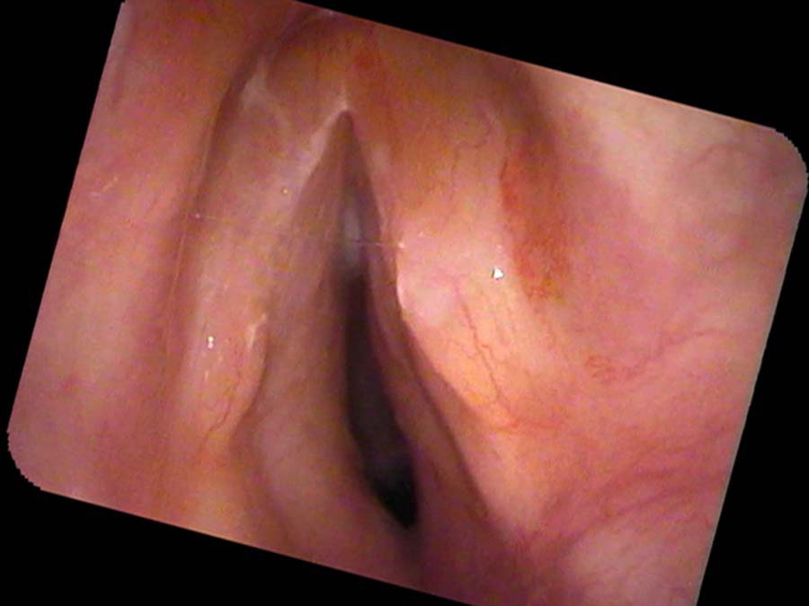 Cricoid cartilage expanded by tumor, narrowing airway to a slit