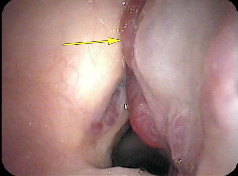 Close-up of blood vessels filling the right false cord