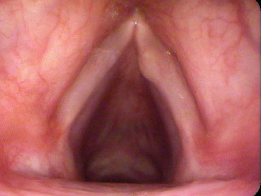 White oval-shaped cyst within the right vocal cord