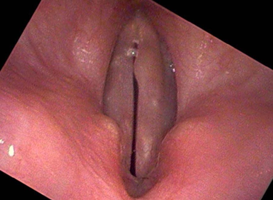 Stroboscopic view showing right vocal cyst protruding and creating gaps