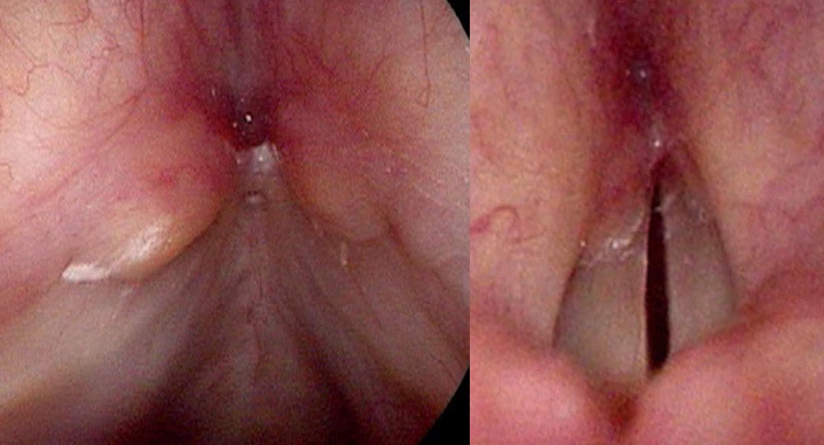 Saccular cysts protruding from the front and bottom edge of the false vocal cords