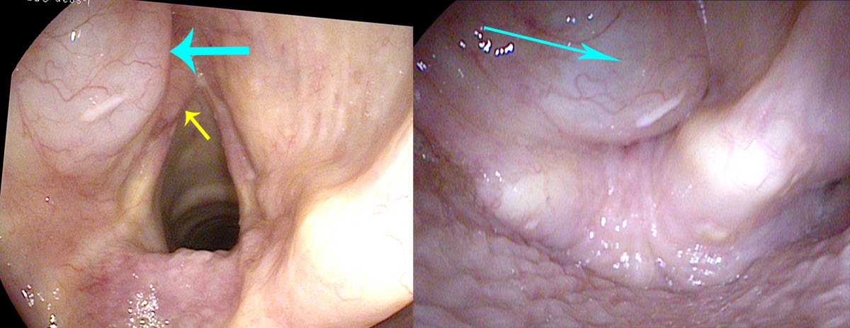 Result after surgical removal of saccular cysts