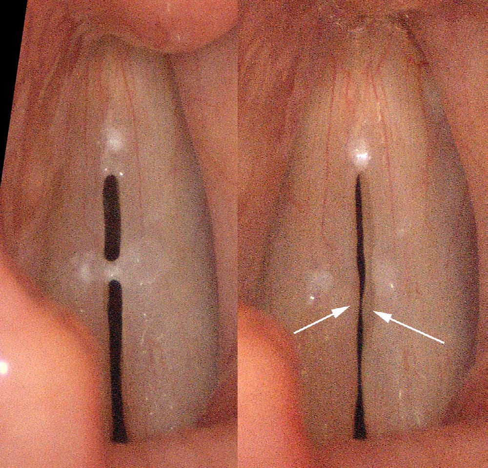 Mucus accumulation on vocal cords revealing underlying swelling