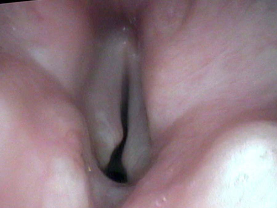 Endoscopy showing left vocal cord shorter and in front of the right vocal cord