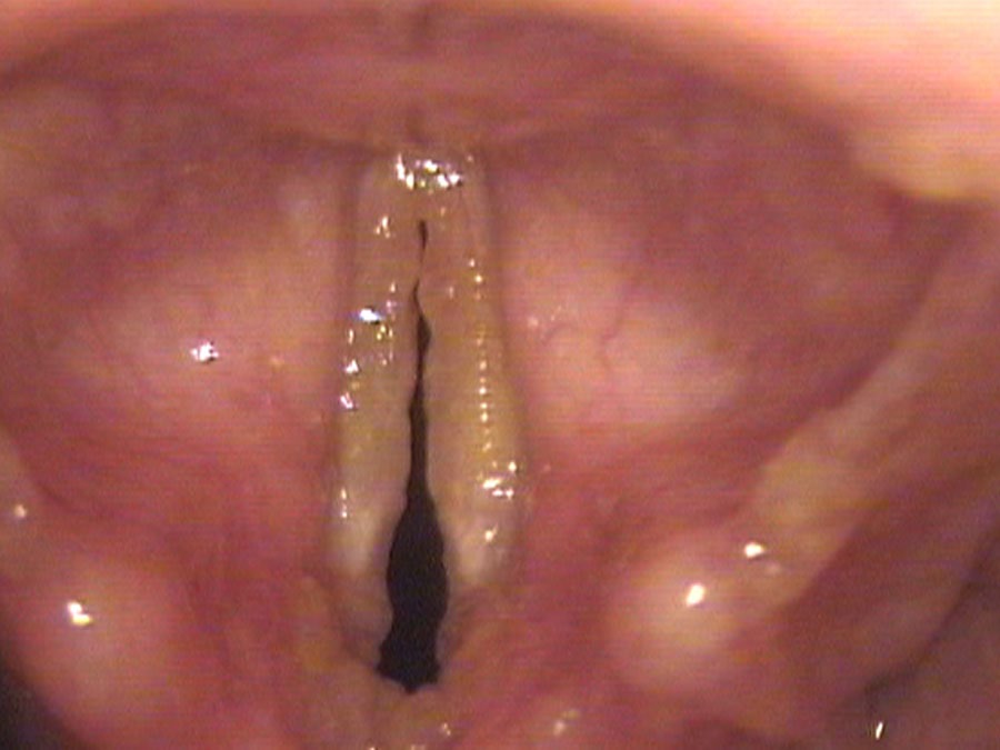 Amyloid deposits along the edges of the vocal cords, standard definition