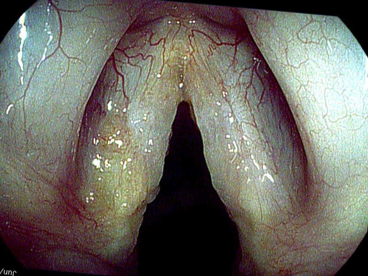 Amyloid deposits on vocal cords, high definition photo