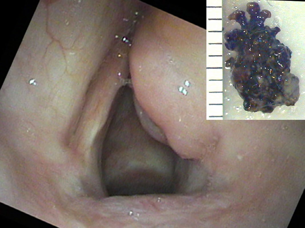 Stone trapped in the right laryngeal ventricle between the true and false vocal cords