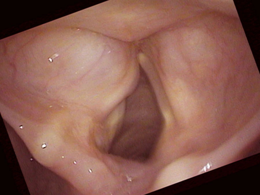 Swollen left false vocal cord obscuring the true vocal cord