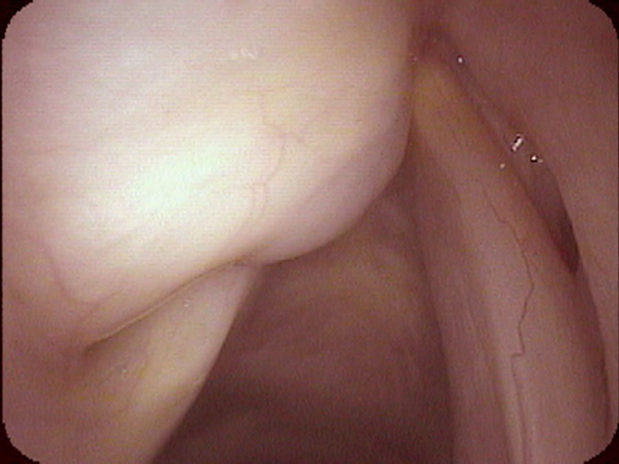 Close-up of left vocal cord during inspiration showing position near midline