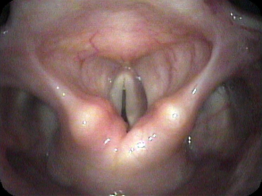 Flexible endoscopic view of Mrs. Tris vocal cords during breathing showing minimal opening