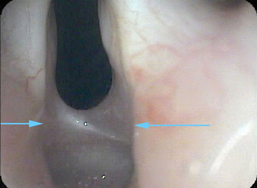 Ultra close-up of back of vocal cords showing scar web preventing opening