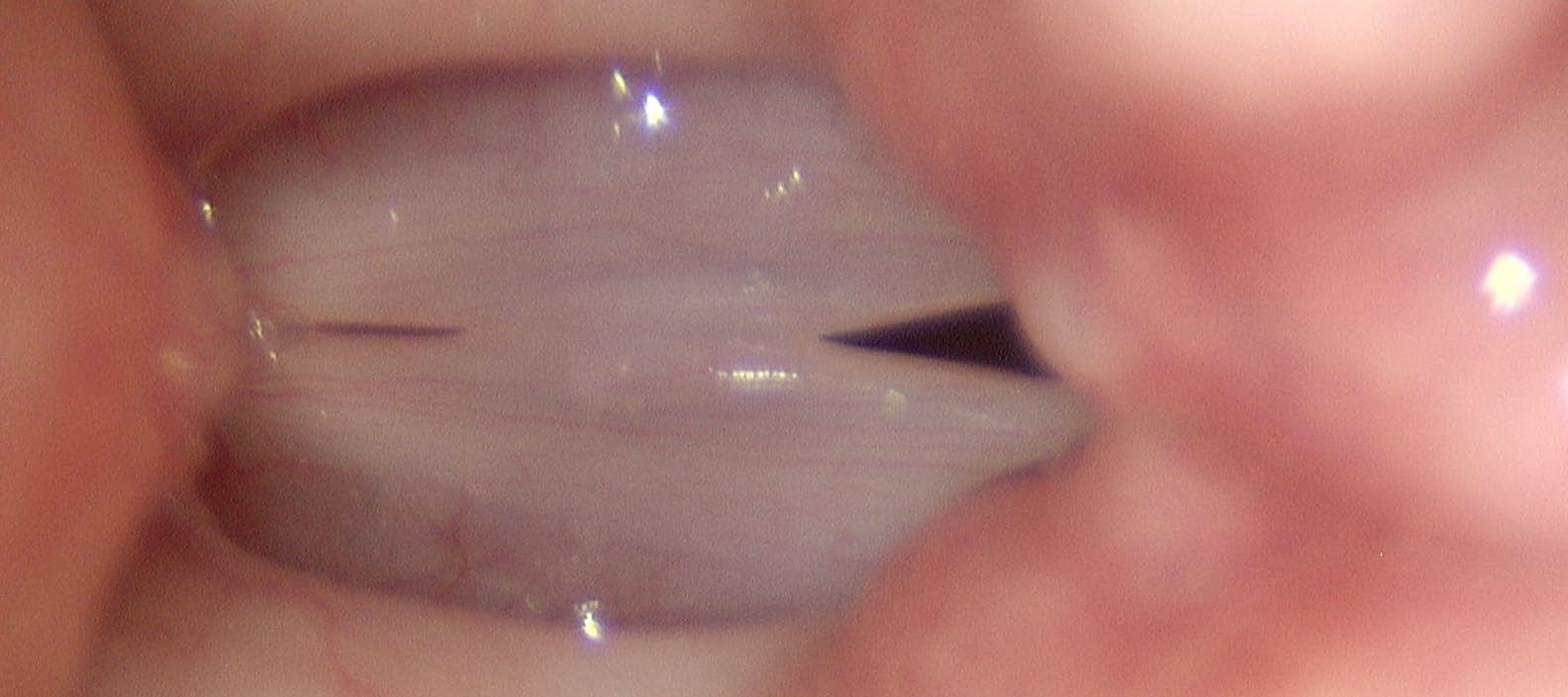 Stroboscopic exam at G3 maximum closed phase showing large dark areas of incomplete glottal closure