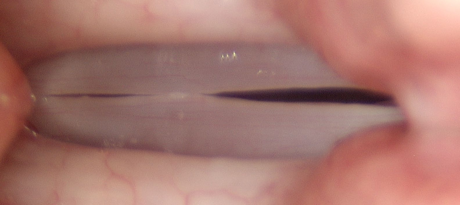 Stroboscopic exam at C5 maximum closed phase showing continued large dark areas of air leak at high pitch