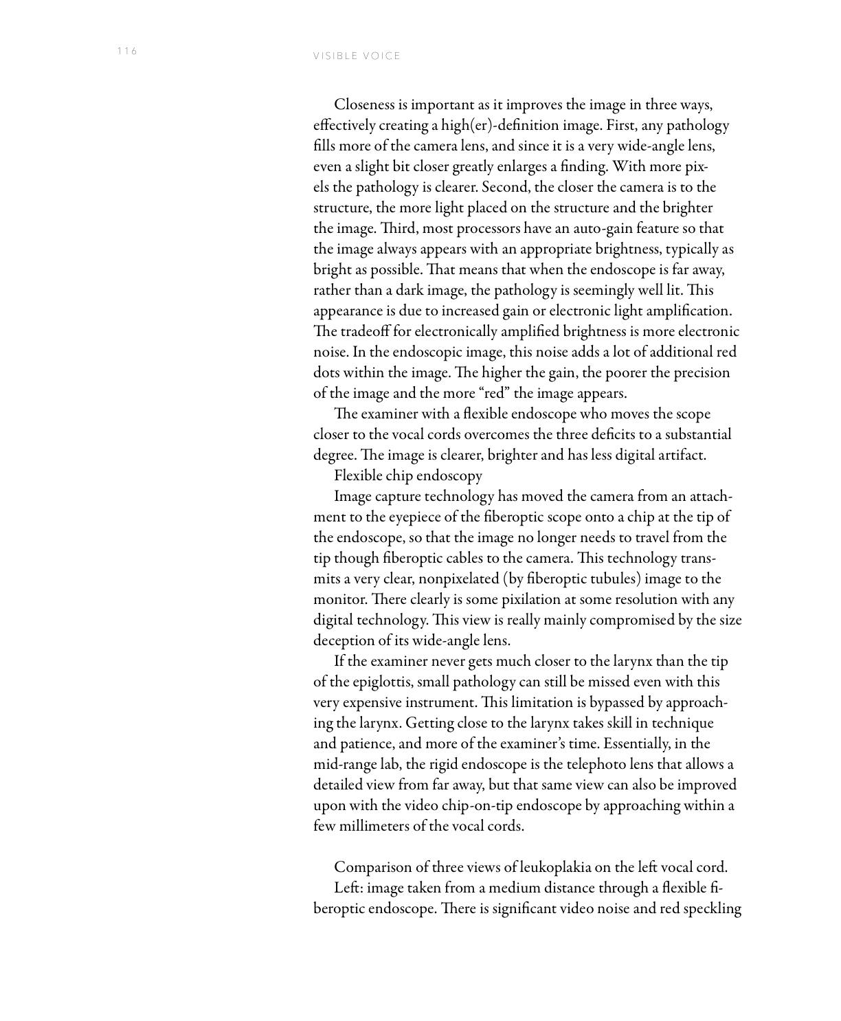 Leukoplakia on the left vocal cord viewed through three endoscope types at increasing closeness
