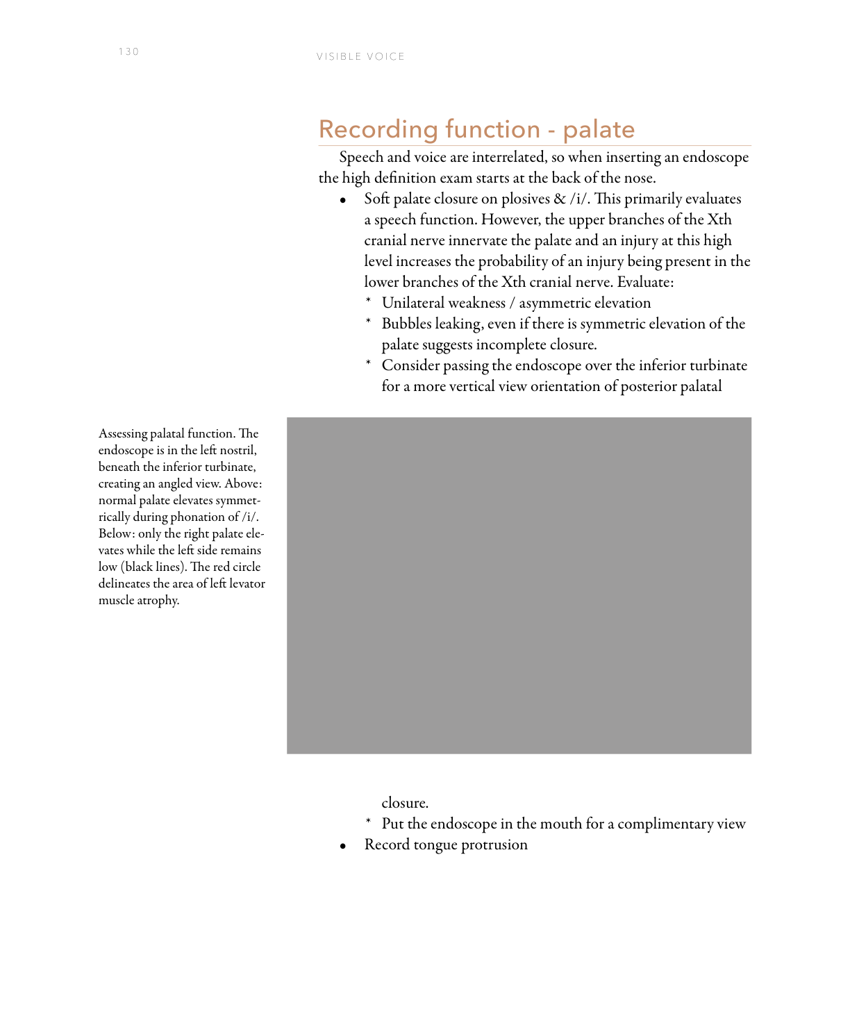 Endoscopic view of palate elevation during phonation: normal symmetric elevation vs. unilateral left weakness