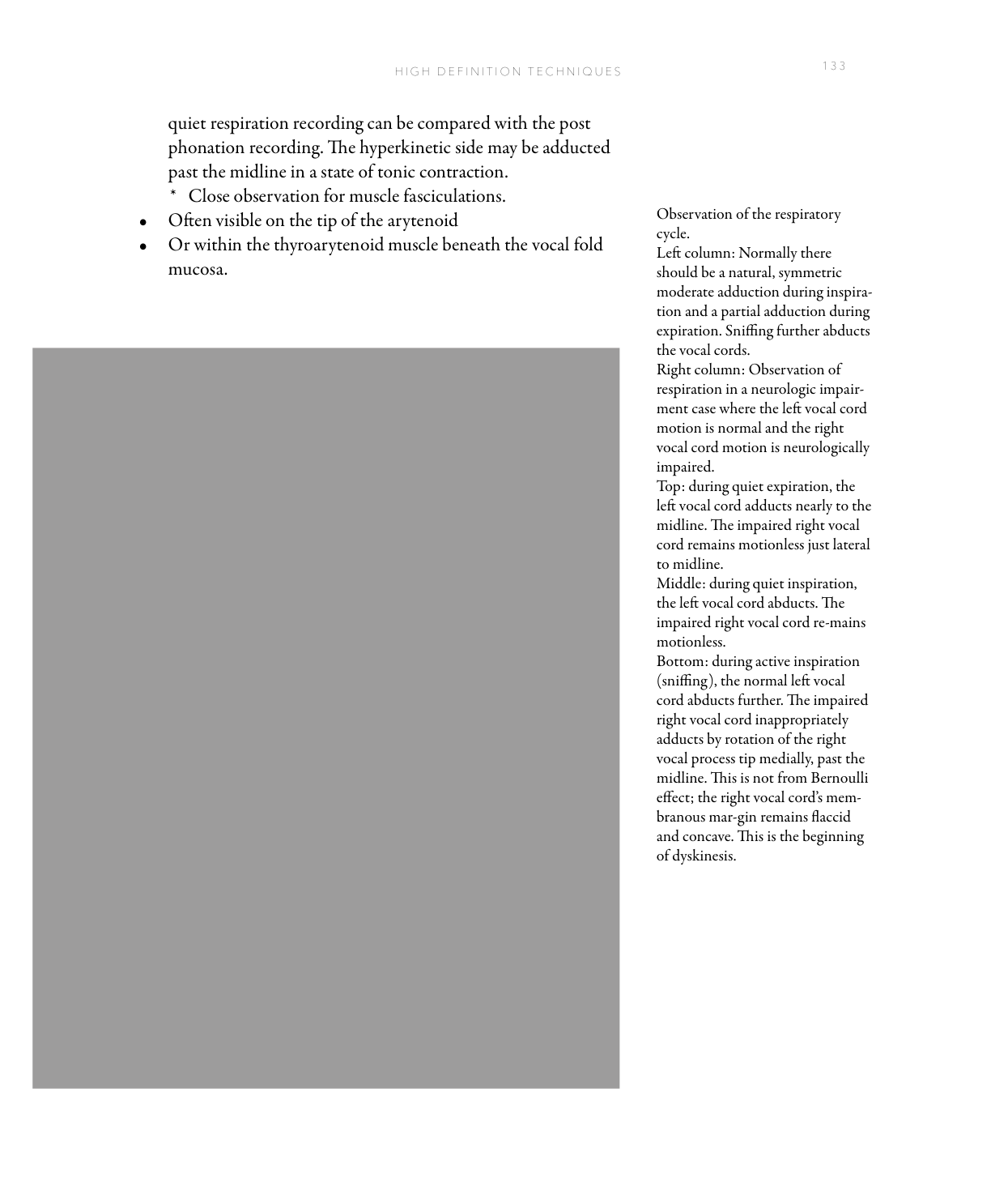 Six-frame respiratory cycle sequence comparing normal vocal cord motion with unilateral neurologic impairment