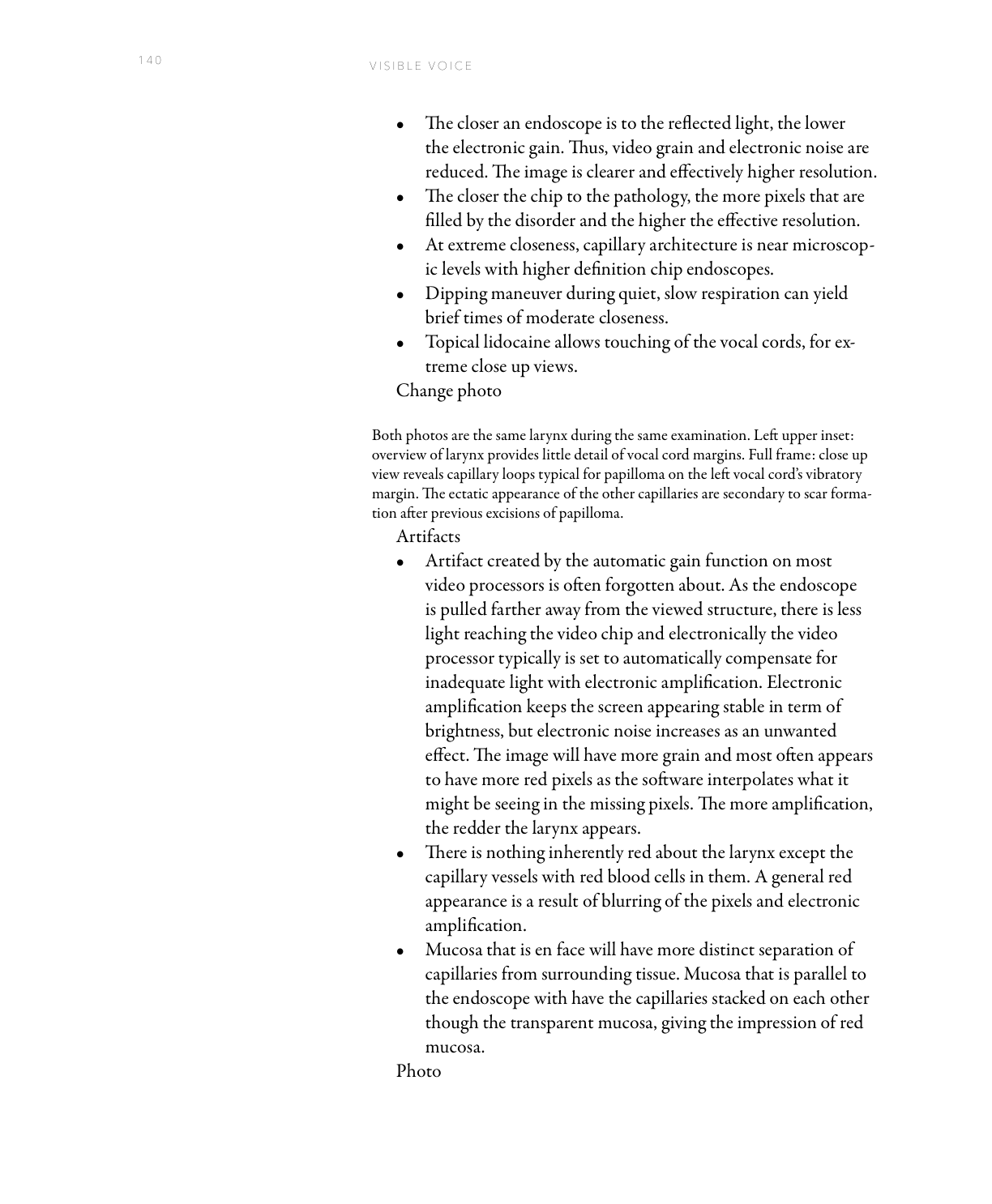 Same larynx: overview from above epiglottis shows only subtle irregularity; close-up reveals papilloma capillary loops