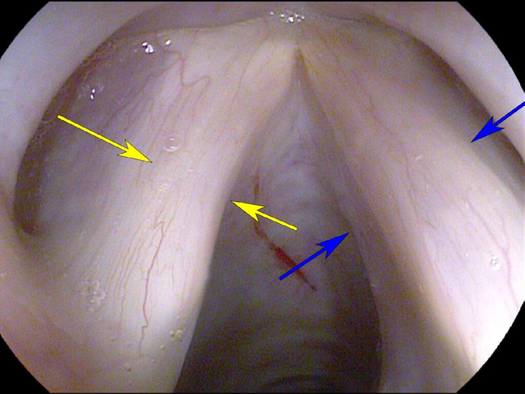 TA muscle bulk viewed from above — subglottic conus