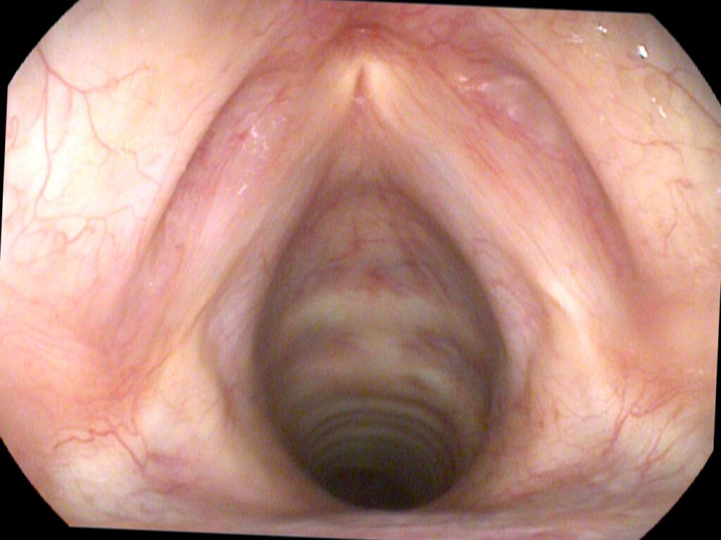Cross-sectional comparison: atrophied left TA vs normal right TA
