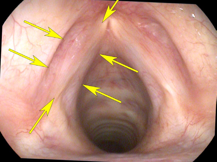 TA muscle viewed from posterior