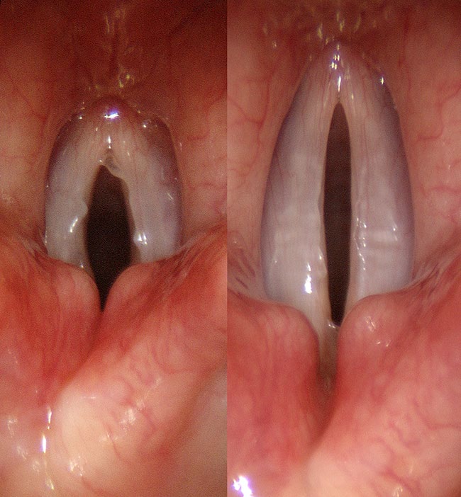 CT muscle effect — vocal cord lengthening with rising pitch