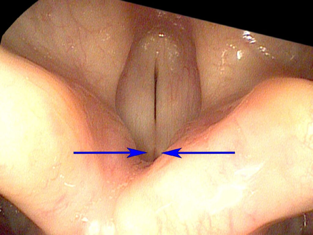LCA muscles bringing vocal cords together at phonatory onset