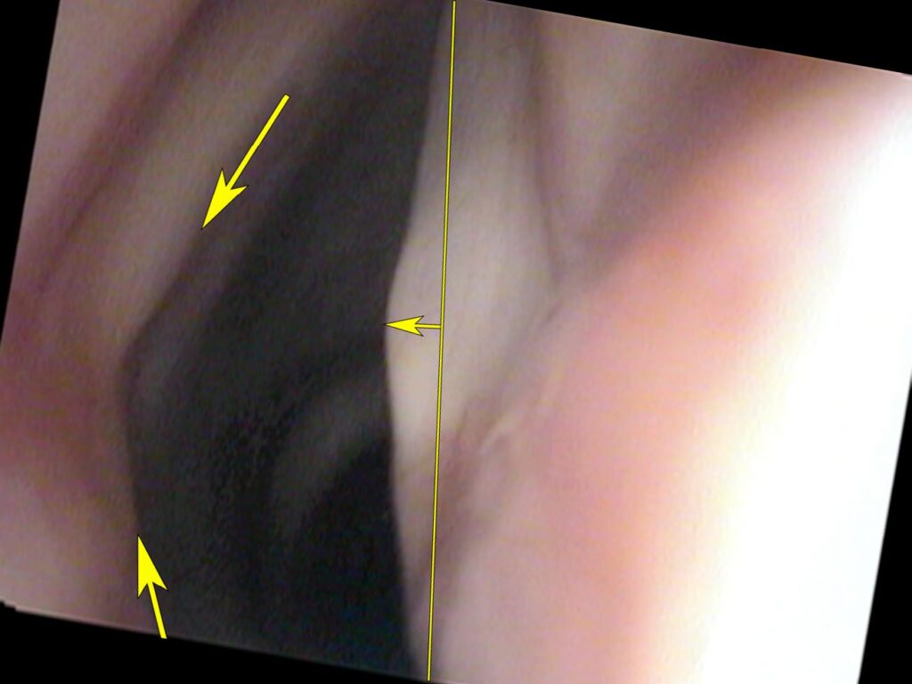 LCA paralysis — compensating vocal process crossing midline