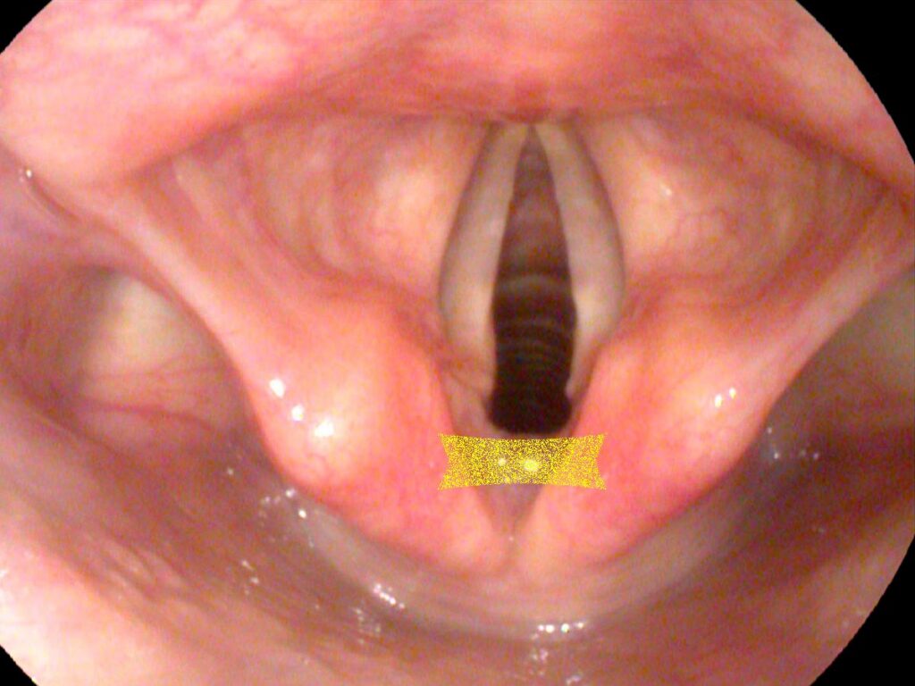 InterArytenoid muscle — midline position between arytenoid cartilages