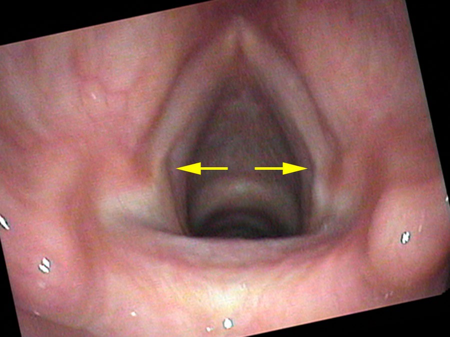 PCA indirect effect — vocal processes abducting on brisk inhalation