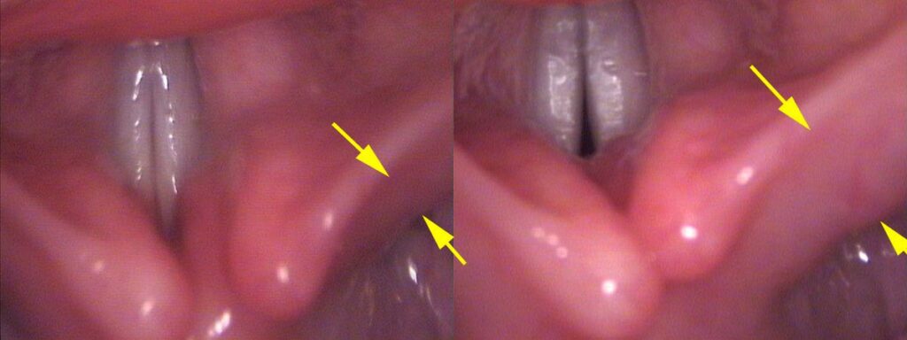 PCA direct visibility — muscle bulk increases on contraction