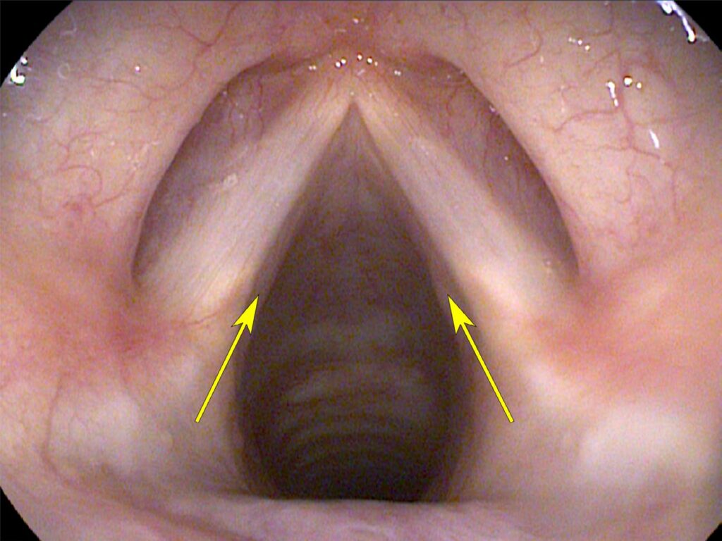 Vocal cords ABducted — breathing position viewed from above