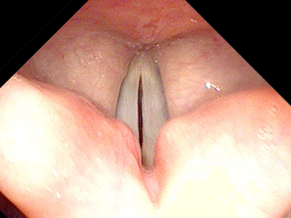 Vocal cords ADducted — onset of phonation at pitch B4