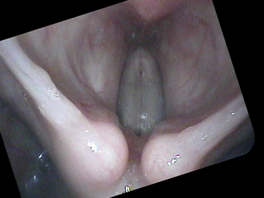 Normal vocal cord closure — pure tone during closed phase at G2