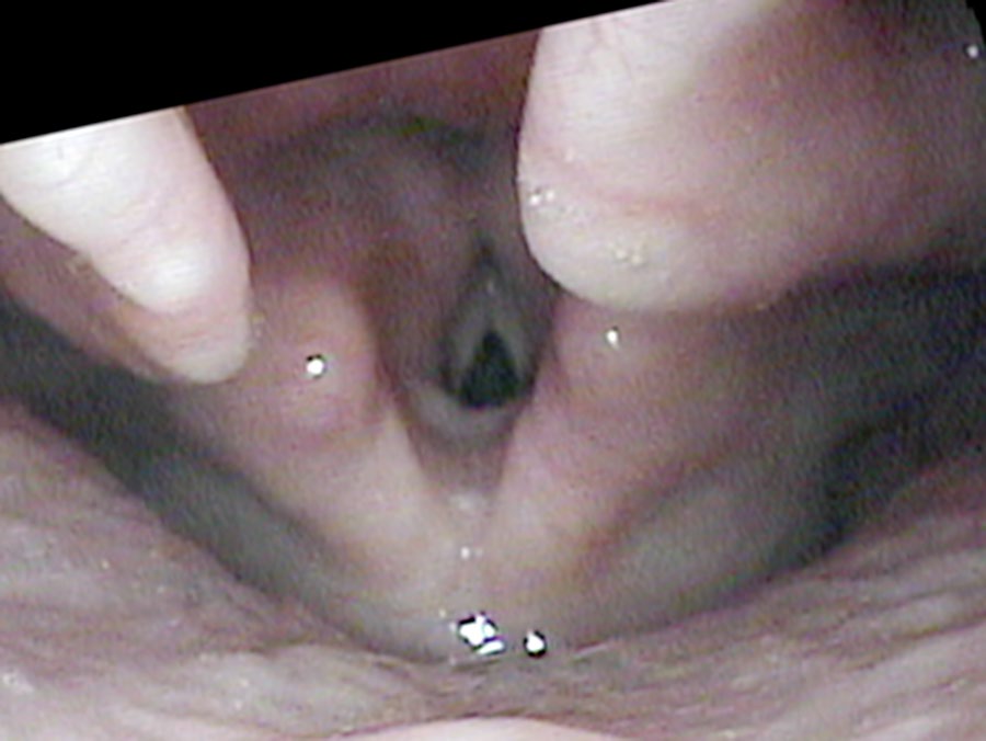 Whisper — posterior triangle of turbulent airflow