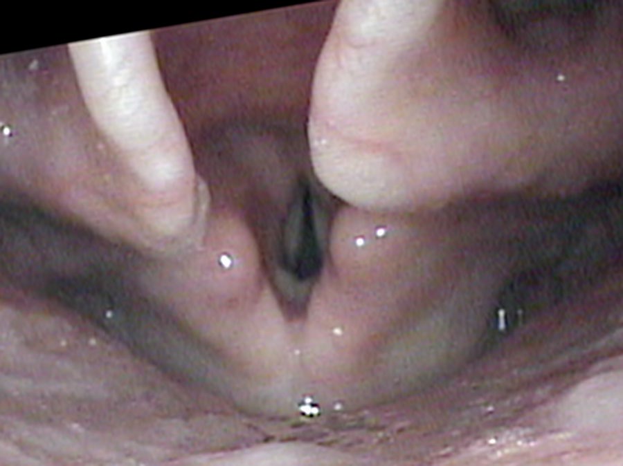 Stage whisper — partial vocal cord vibration with air leak