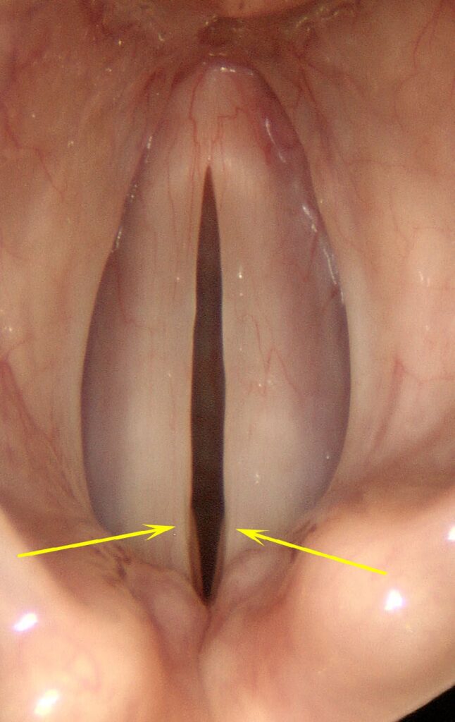 Posterior gap — incomplete closure at vocal processes