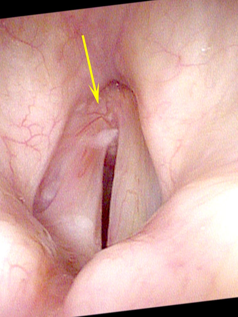 Anterior gap after removal of squamous cell carcinoma