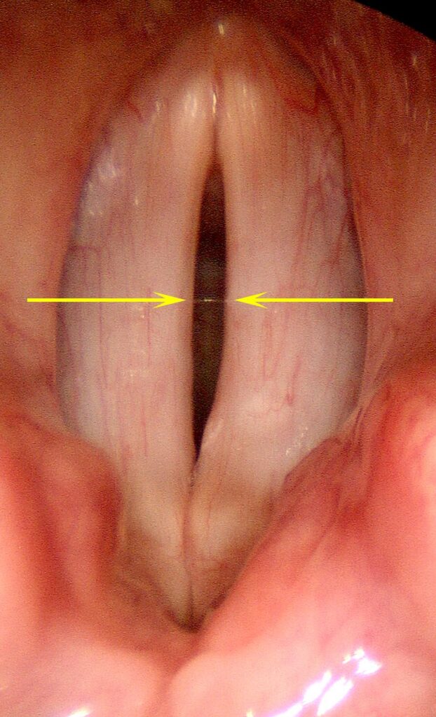 Symmetric central gap with overclosure of vocal processes