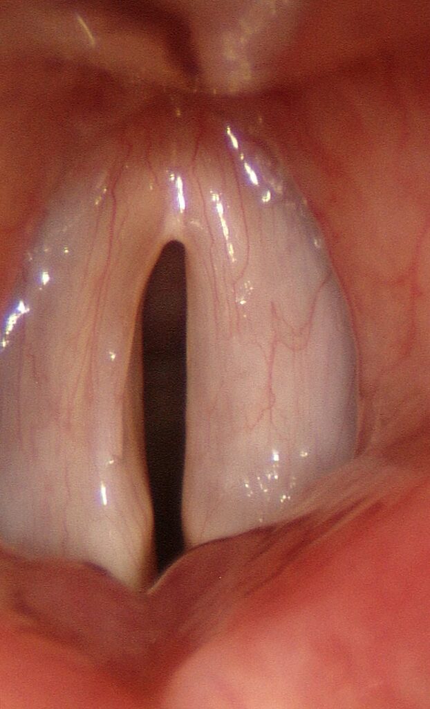 Asymmetric central gap — left recurrent laryngeal nerve paresis