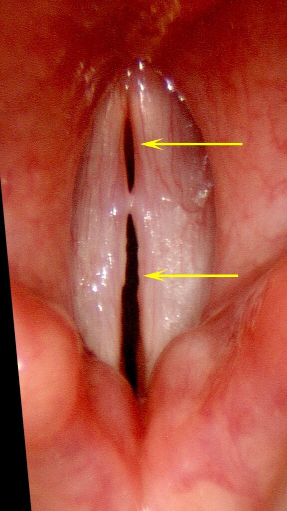 Split gap — bilateral vocal swellings prevent complete closure
