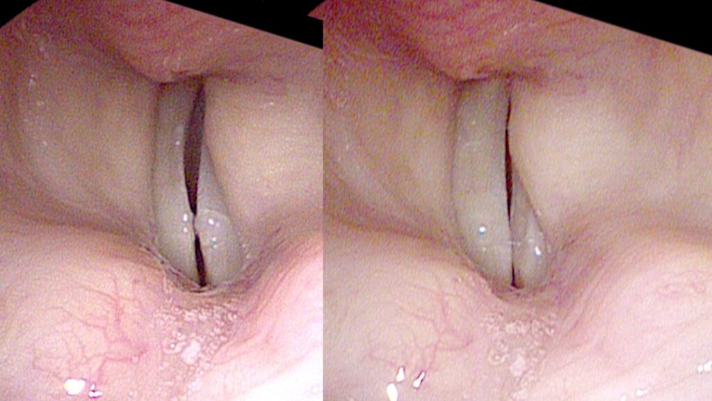 Timing gap — asynchronous vocal cord movement