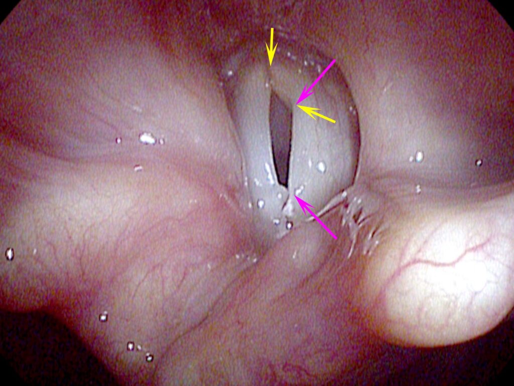 Asymmetric tension — wild oscillation pattern at low pitch
